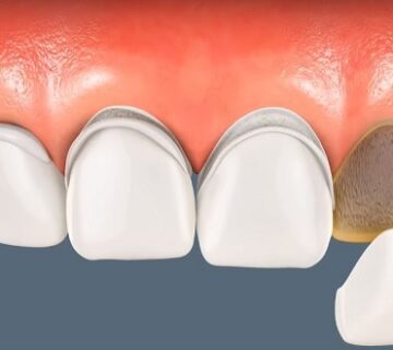 الفرق بين الفينير واللومينير