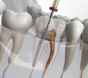 هل يسقط السن بعد سحب العصب
