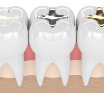 حشوات الاسنان التجميلية