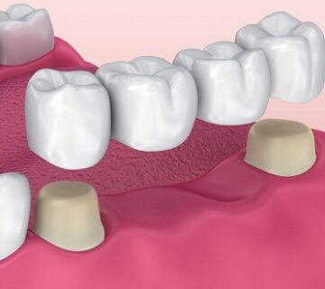 انواع جسور الاسنان