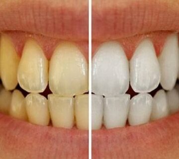 عيادة تبييض اسنان في جدة