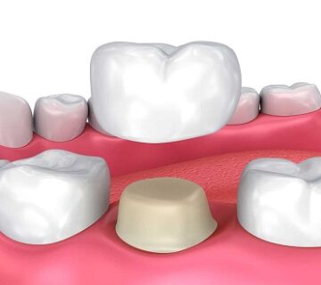 ما هي اسباب سقوط تلبيسة الاسنان؟