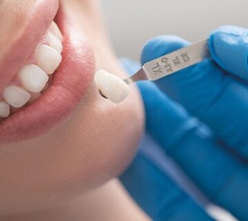 كم تدوم تركيبات الاسنان