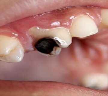 انواع تسوس الاسنان