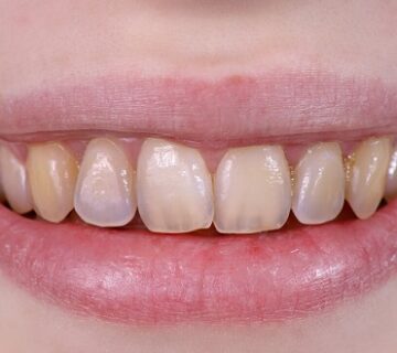 اسباب ضعف الاسنان