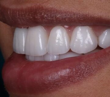 اهم الطرق للعناية بعدسات الاسنان